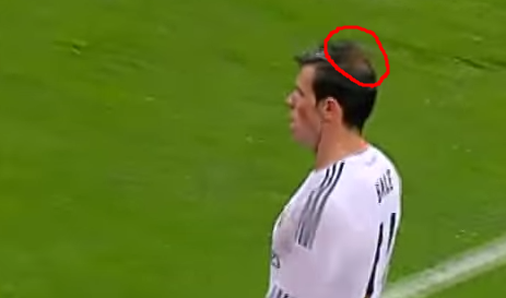 Gareth Bale Hair Loss  His Man Bun & Hair Transplant Rumours